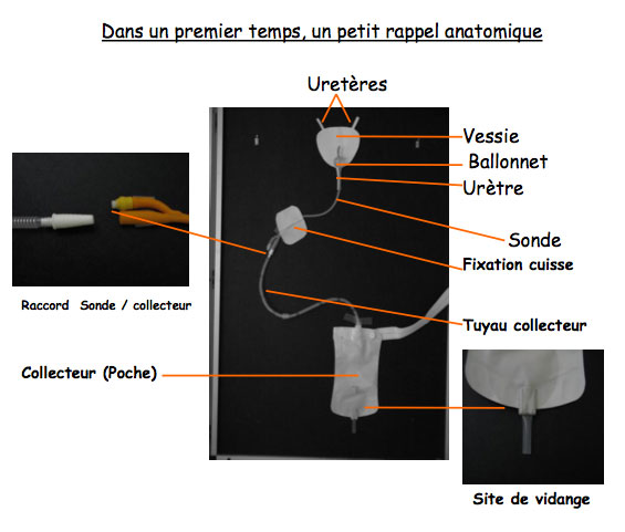 Sonde urinaire : Indication, mise en place, risques d'infection