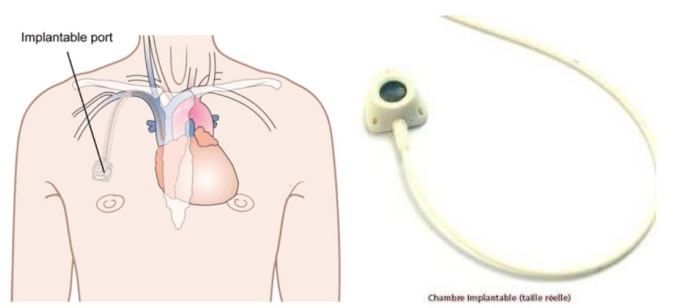 La mise en place d'un cathéter à Chambre Implantable Percutanée ...