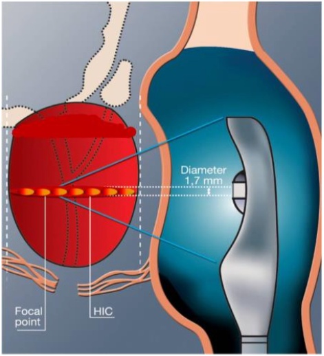 cancer prostate1